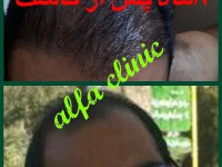کلینیک کاشت مو  و زیبایی آلفا